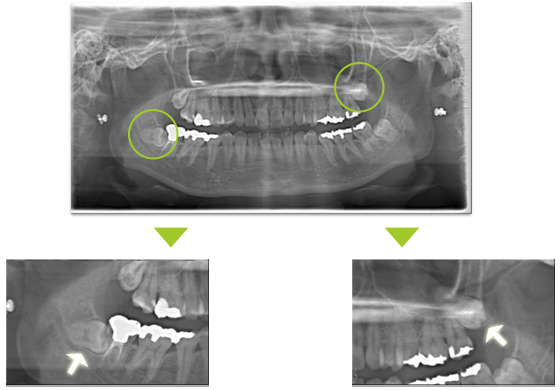 親知らずの症例